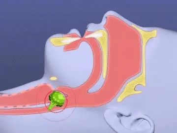 LifeVac Anti Choking Device for Adults and Babies